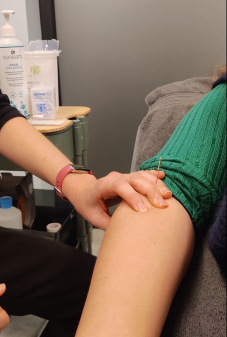 dry needling